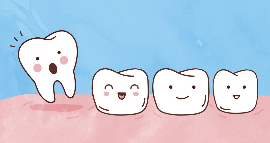 extractie-molar-de-minte-experienta-mea